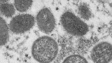 CDC shows 5 cases of monkeypox in Indiana – WISH-TV | Indianapolis News | Indiana Weather