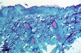 CDC Raises Travel Alert for Monkeypox