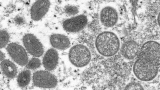 US monkeypox infections climb to 65