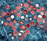 Monkeypox: U-M experts discuss symptoms, spread