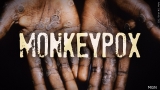 Monkeypox is not COVID-19. Here’s why