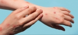 CDC Raises Monkeypox to a Level 2 Advisory