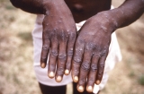 World Health Organization declares monkeypox a global emergency