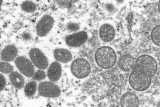 UK: Monkeypox cases rise to 1,735 with most cases in London