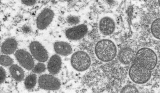 Monkeypox genetic material tracked through wastewater surveillance helps show extent of spread
