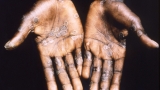 More than 200 people being tracked for possible monkeypox exposure