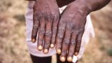 Pharma firms planning vaccines, drugs, testing kits as monkeypox spreads