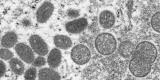 Some monkeypox cases more severe than ‘originally thought’