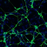 Deteriorating Neurons Are Source Of Human Brain Inflammation In Alzheimer’s Disease
