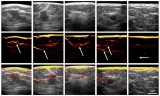 Optoacoustic imaging identifies breast cancer from vascular patterns – Physics World