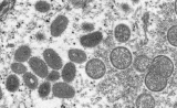 Monkeypox case confirmed in Massachusetts, CDC monitoring