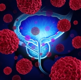 Prognosis of prostate cancer patients improved through significant discovery