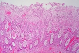 The tiny killer in your gut – Health News