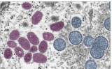 CDC Issues New Monkeypox Guidance Amid Increase In Cases