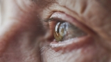 CDC Report Warns of Serious Ocular Complications With Monkeypox