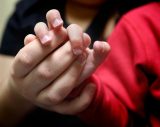 Hepatitis outbreak in children: CDC on symptoms parents should look for