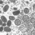 Monkeypox cases may have been spreading undetected in US, Europe for years