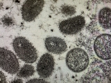 Monkeypox found in the Midlands, CDC notified