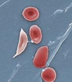 Too few kids with sickle cell get stroke screen, care