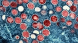 UK: ‘Early signs’ that monkeypox outbreak may be peaking