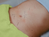 Acupuncture for eczema: Does it work?