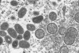 First probable case of monkeypox identified in Kentucky