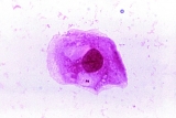Florida health officials, CDC warn of meningitis outbreak