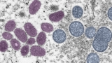 Maine CDC reports third case of monkeypox