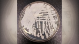 State, CDC officials continue to investigate superbug – News3LV