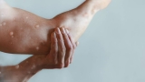 What Nurses Need To Know About Monkeypox