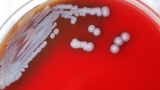 What is melioidosis? CDC issues alert after bacteria found in MS