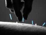 Preventing type 2 diabetes: Could acupuncture help?