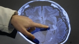 What you need to know about strokes and young people : Shots