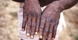 Pima County health seminar on monkeypox