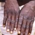 Penn Highlands Healthcare Provides Details About Monkeypox – GantNews.com