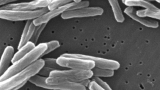 CDC investigating tuberculosis outbreak linked to more than 100 spinal surgeries