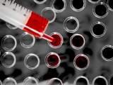 Blood proteins test may speed up diagnosis by 2 years