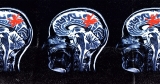 Could controlling the brain’s own clean-up crew help?