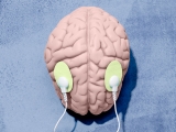 Can brain stimulation treat ‘brain fog’?