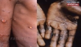 Philippines tightens border control amid monkeypox threat │ GMA News Online
