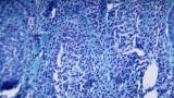 Maryland has more monkeypox cases, CDC says