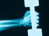 Calcium phosphate: What is it and what are the risks? – Medical News Today