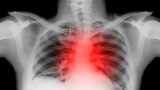 How common are cardiovascular problems after COVID? : Shots