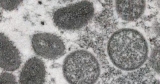 World Health Organization says it’s “not concerned” about monkeypox becoming pandemic