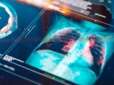 Can a Past Disease Help Us Understand COVID-19?