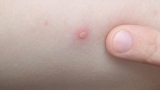 Canada confirms 168 cases of monkeypox | World News