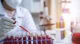 Mayo Clinic Laboratories to begin monkeypox testing in CDC partnership