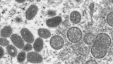 69 monkeypox cases across the Carolinas: Symptoms, who qualifies for vaccines & testing – wpde.com