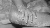 Monkeypox infection in Georgia | CDC provides update
