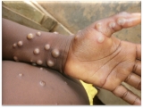 T&T places indicative order with PAHO to secure monkeypox vaccines